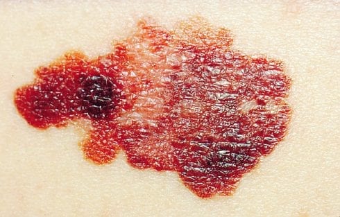 Skin cancer rates in Spain rise alarmingly