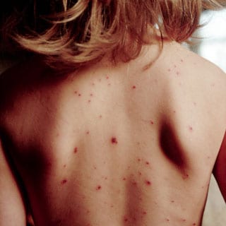 Measles surge leads to calls for earlier vaccinations Measles surge leads to calls for earlier vaccinations