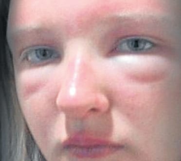 British schoolgirl faces sunglasses horror during holiday in Spain British schoolgirl faces sunglasses horror during holiday in Spain