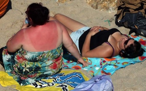 sunburn k e