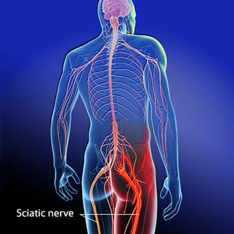 Sciatica