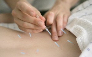 FILE - In this Monday, Sept. 24, 2007 file photo, Anah McMahon, L. Ac. adjusts one inch seirin acupuncture needles in the muscles around the spine of a patient to relieve lower back pain, at the Pacific College of Oriental Medicine in Chicago. Acupuncture gets a thumbs-up for helping relieve pain from chronic headaches, backaches and arthritis in a review of more than two dozen studies - the latest analysis of an often-studied therapy that has as many fans as critics. The new analysis was published online Monday, Sept. 10, 2012 in Archives of Internal Medicine. (AP Photo/M. Spencer Green) ORG XMIT: NY810