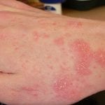 Scabies surges in Spain: Health experts detect 44 outbreaks since early November - with 11 linked to schools