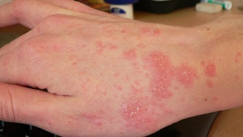 Scabies surges in Spain: Health experts detect 44 outbreaks since early November - with 11 linked to schools