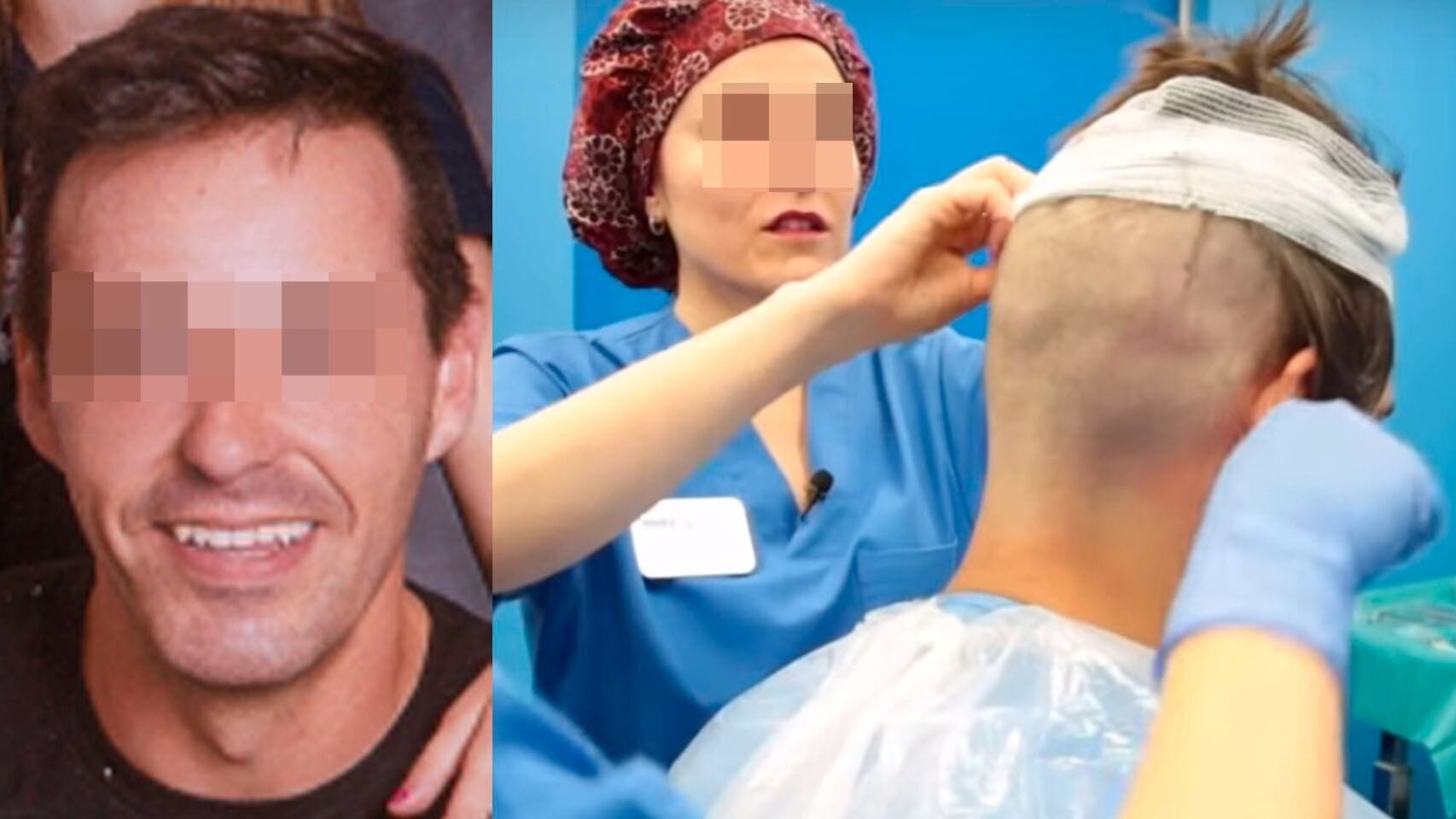 Man in Spain dies of heart attack during hair transplant just moments after  receiving anaesthetic - Olive Press News Spain