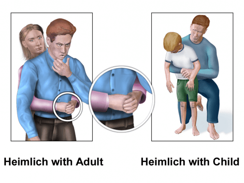 Heimlich