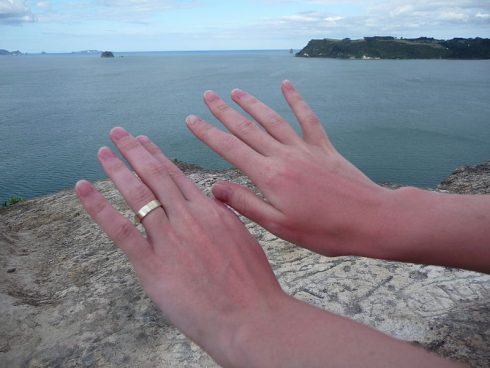 800px Sunburn_on_hands_after_a_day_at_hot_water_beach _new_zealand 12dec2008