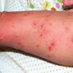 Scabies surges in Spain: Health experts detect 44 outbreaks since early November - with 11 linked to schools