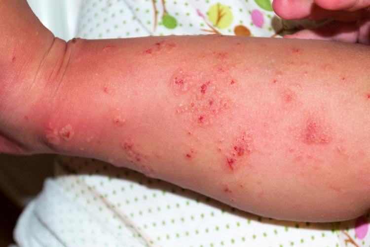 Scabies surges in Spain: Health experts detect 44 outbreaks since early November - with 11 linked to schools