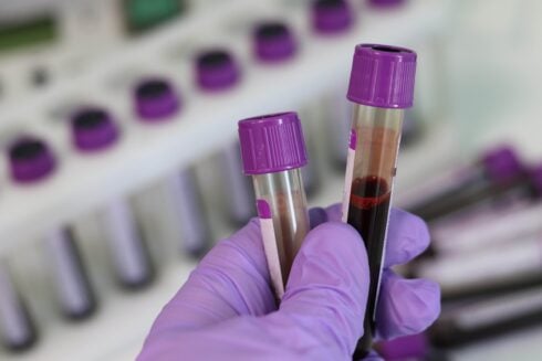 Spanish health expert gives 'little tip' to improve blood test results